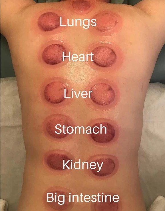 Cupping